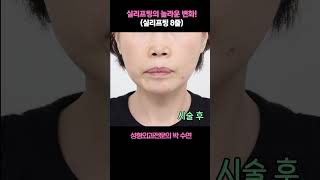 실리프팅의 놀라운변화 (실리프팅8줄)!? #올리고당 #실리프팅#박수연원장
