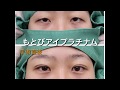 もとびアイプラチナム（二重埋没法）の動画