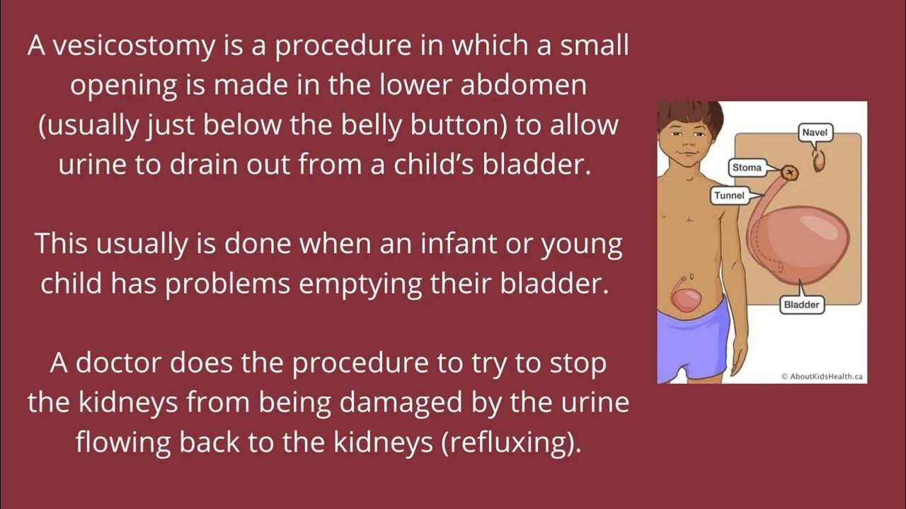 VESICOSTOMY YouTube