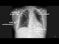 Tubos y lineas en la Radiografía de Tórax