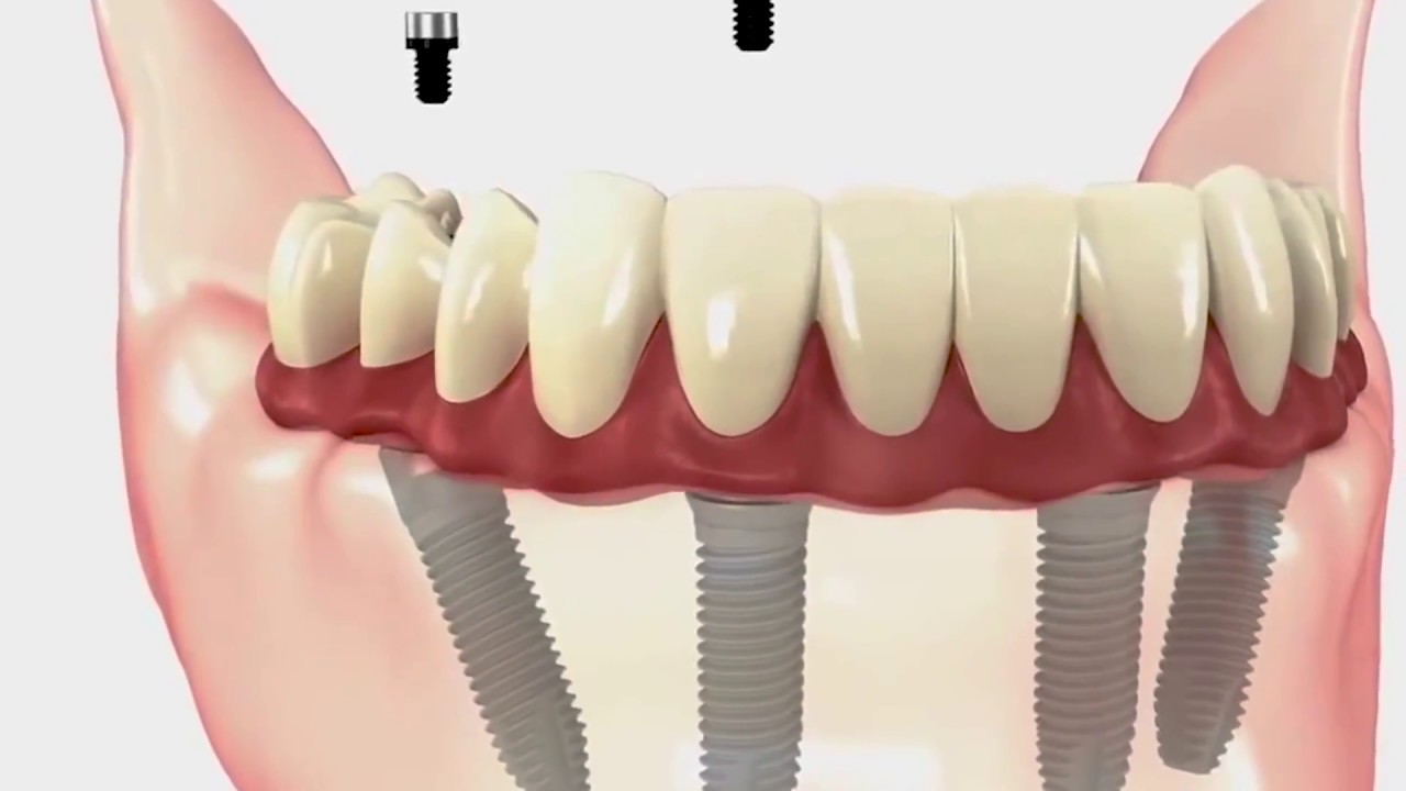 Traditional Dentures vs Implant supported Dentures Billings, MT Dr. Brian Francis YouTube