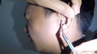 Removing Something BLACK Trapped in Man's Ear | What is It? by Earwax Specialist 47,078 views 2 months ago 1 minute, 16 seconds