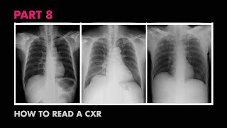 Diaphragms and Pleural Effusion  How to Read a Chest XRay (Part 8)  MEDZCOOL