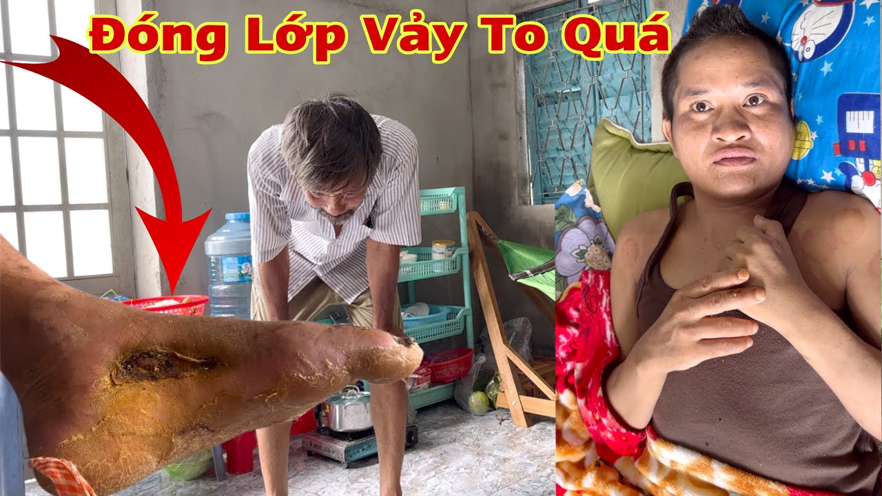 Tình Hình A Rắn Cắn Vết Thương Đóng Vảy Da Chân Đang Thay YouTube