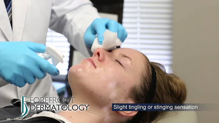 Learn about Chemical Peels - Forefront Dermatology