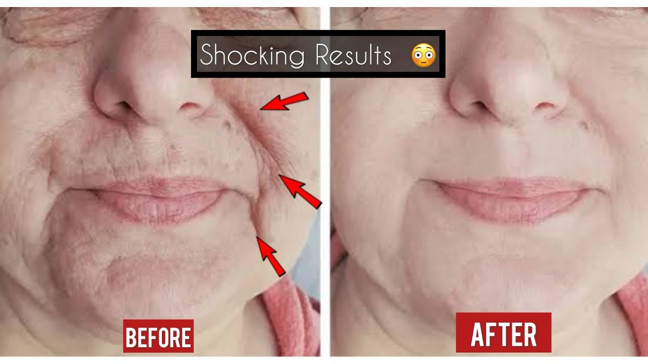 Just 2 ingredients skin tightening and face lifting home remedy| botox ...