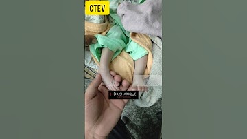 CTEV Foot 👣 Deformity #shorts #viral #trending #foot #deformity #doctor #cast #ctevcast #congenital