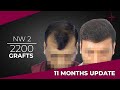 Grade 2 baldness result  2200 fuedht grafts 11month update at eugenix hair sciences india