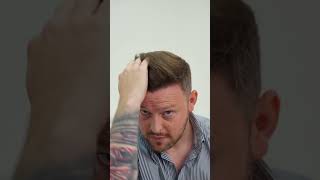 Hair Transplant Turkey Before After Transformative Journey With Este Medical Group