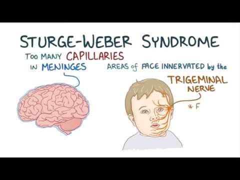 sturge-weber syndrome