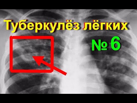 Туберкулез легких. Лечение туберкулеза народными средствами в домашних условиях - № 6 | ed black