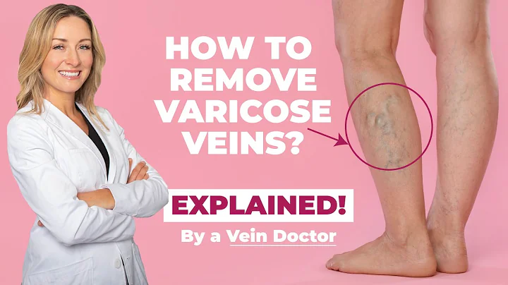 How to Remove Varicose Veins? A Vein Doctor Explains!