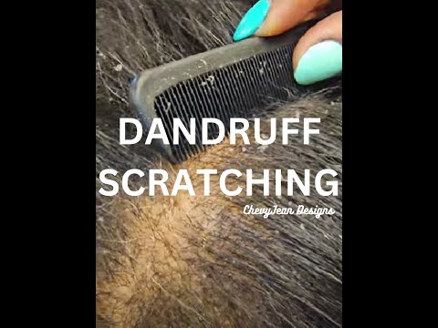I lifted my client's dandruff before a relaxing shampoo. #dandruff