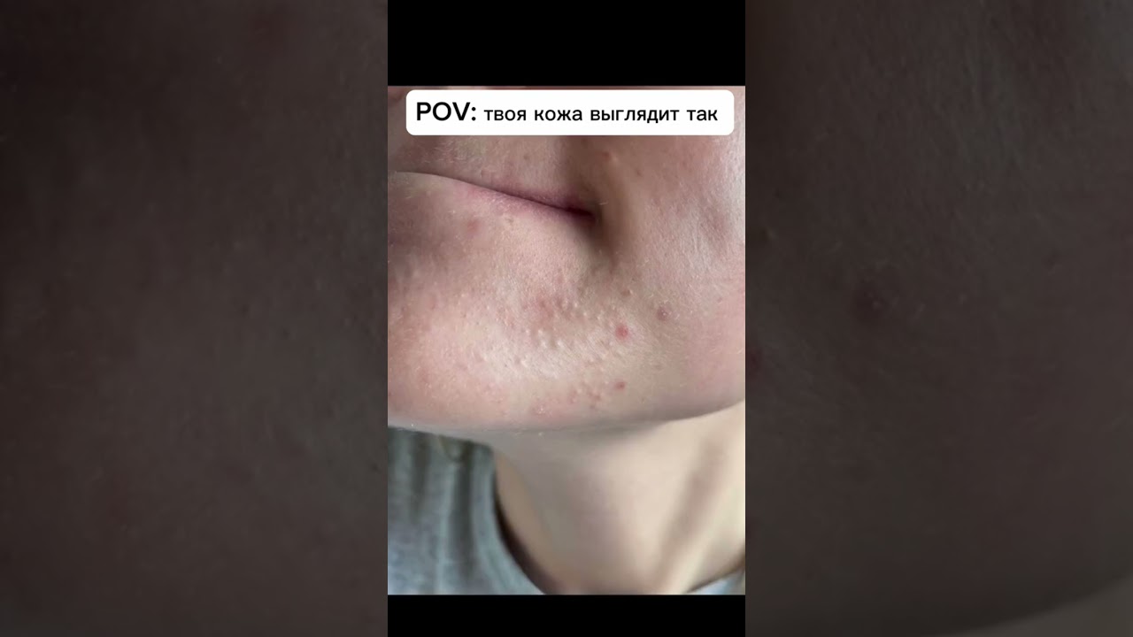 Лечение комедонов