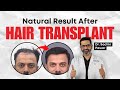 Natural result after hair transplant  dr sachin pawar  hairmd pune