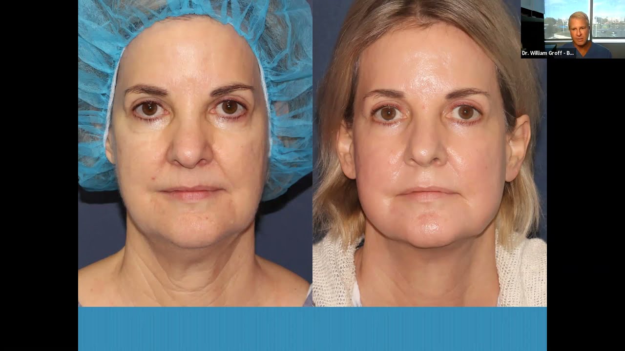 Banner for Introducing ThermiSculpt³ for Neck and Jawline Rejuvenation with Dr. William Groff