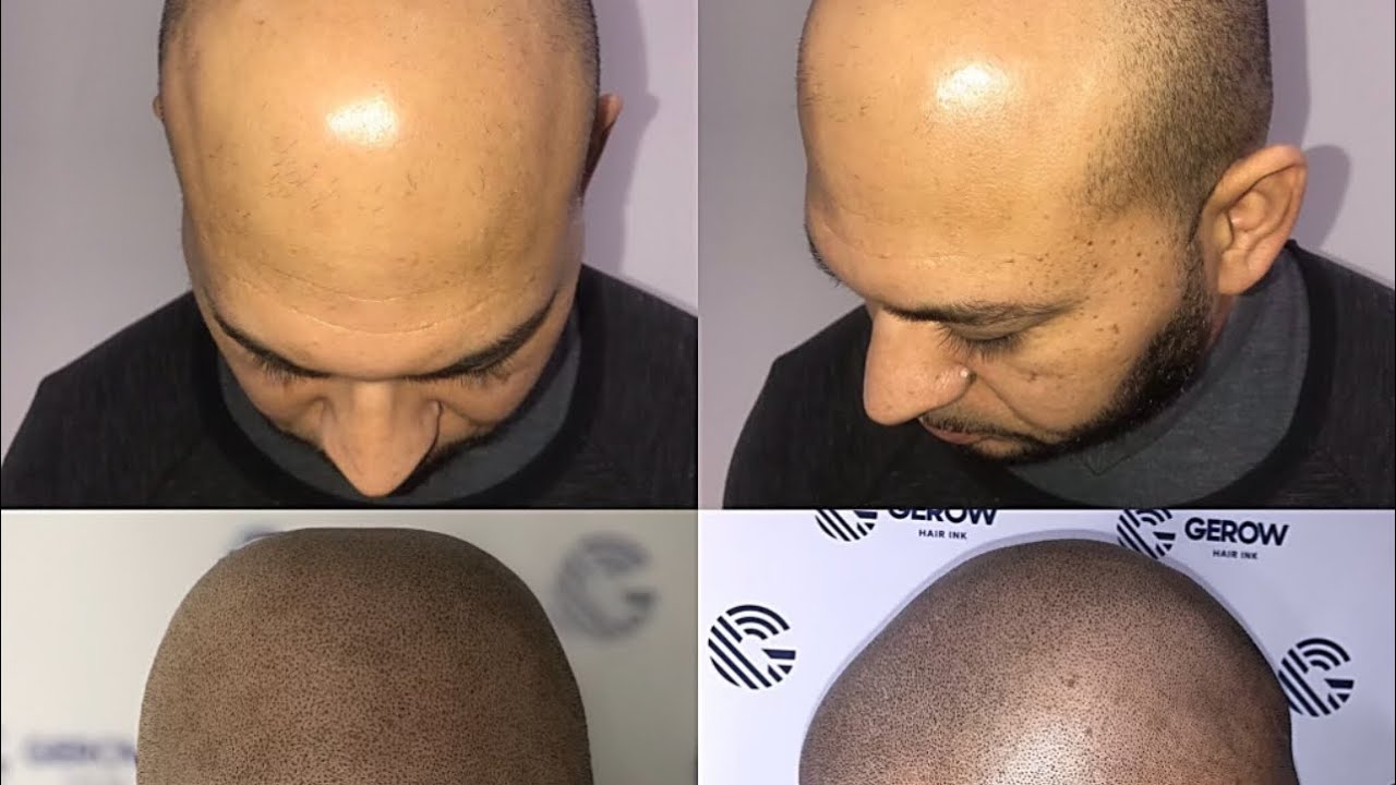 Микропигментация кожи головы: первые 3 сеанса