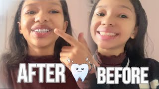 🪥 Going to the dentist vlog 🦷 let’s talk ! #dentist #vlog #letstalk