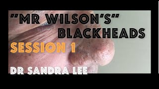 Session 1: "Mr Wilson" Extracting large blackheads on the nose