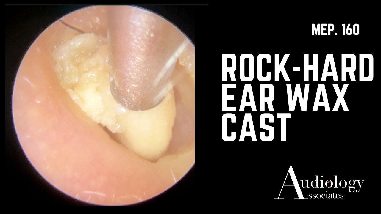 Ear Rocks Treatment Rock-Hard Ear Wax Cast – Nearly the Full Ear Canal (Members’ Voiceover ...