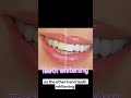 scaling #teeth whitening # difference #gaurdental # smile
