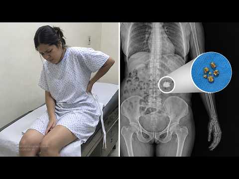 How kidney stones form. Tell your children