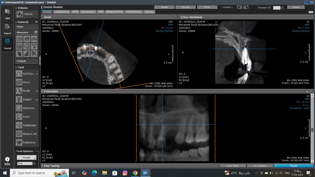 Dental CBCT Analysis | تحليل الأشعة المقطعية ثلاثية الأبعاد 