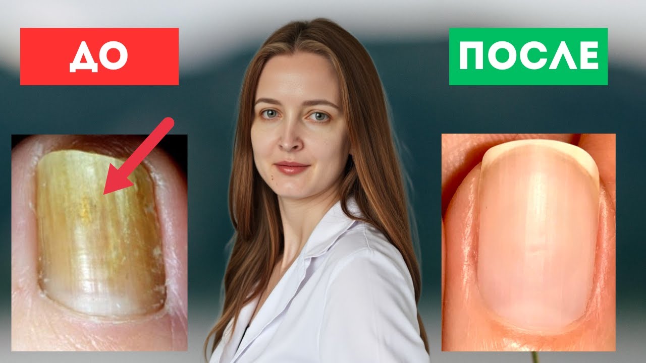 Как ПОБЕДИТЬ грибок ногтей раз и навсегда? Разбор от дерматолога