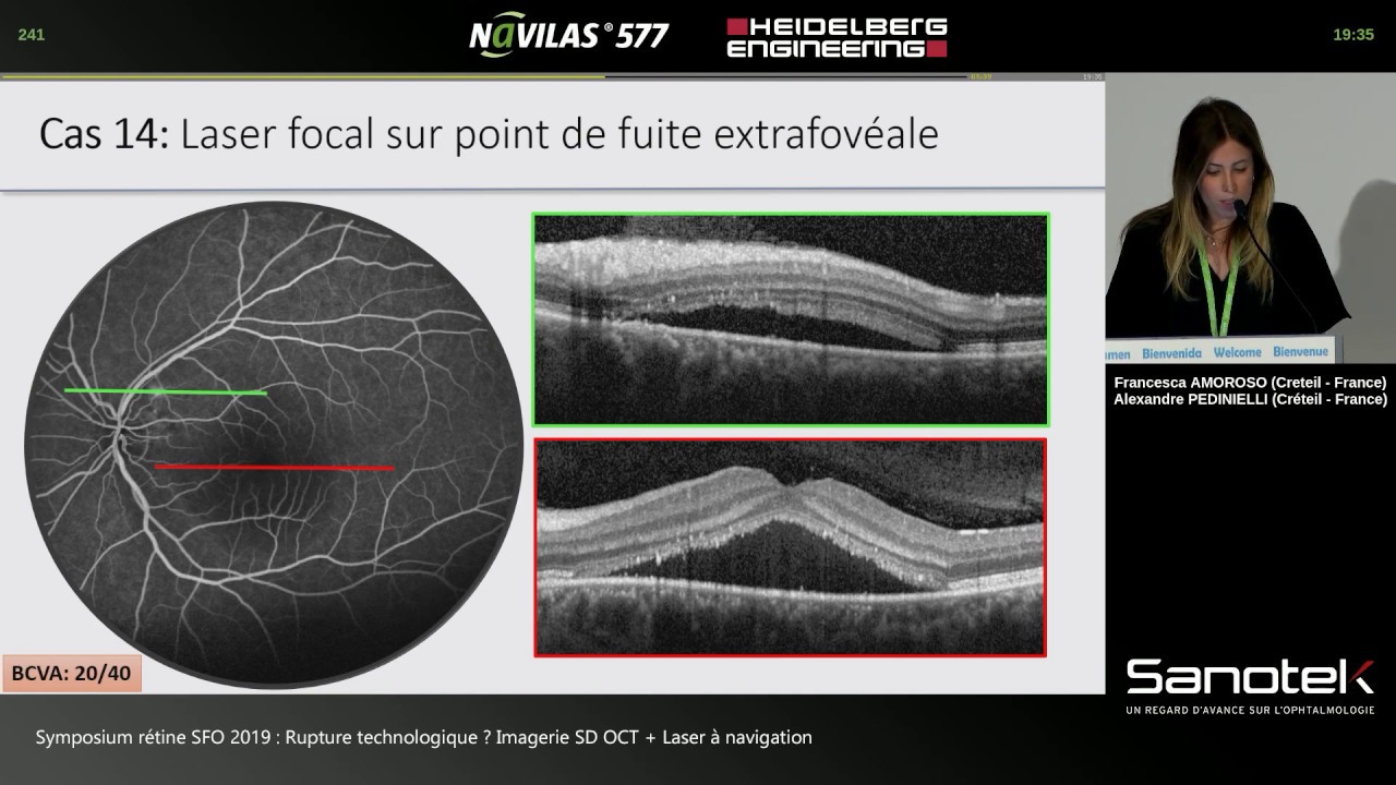 Cas cliniques au laser rétinien Navilas 577s - Dr Francesca AMOROSO et Dr Alexandre PEDINIELLI