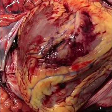 Cardiac Tamponade - Post-Mortem Gross Specimen