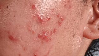 Documentation 18 Time-lapse Hormonal Acne Breakouts ewww