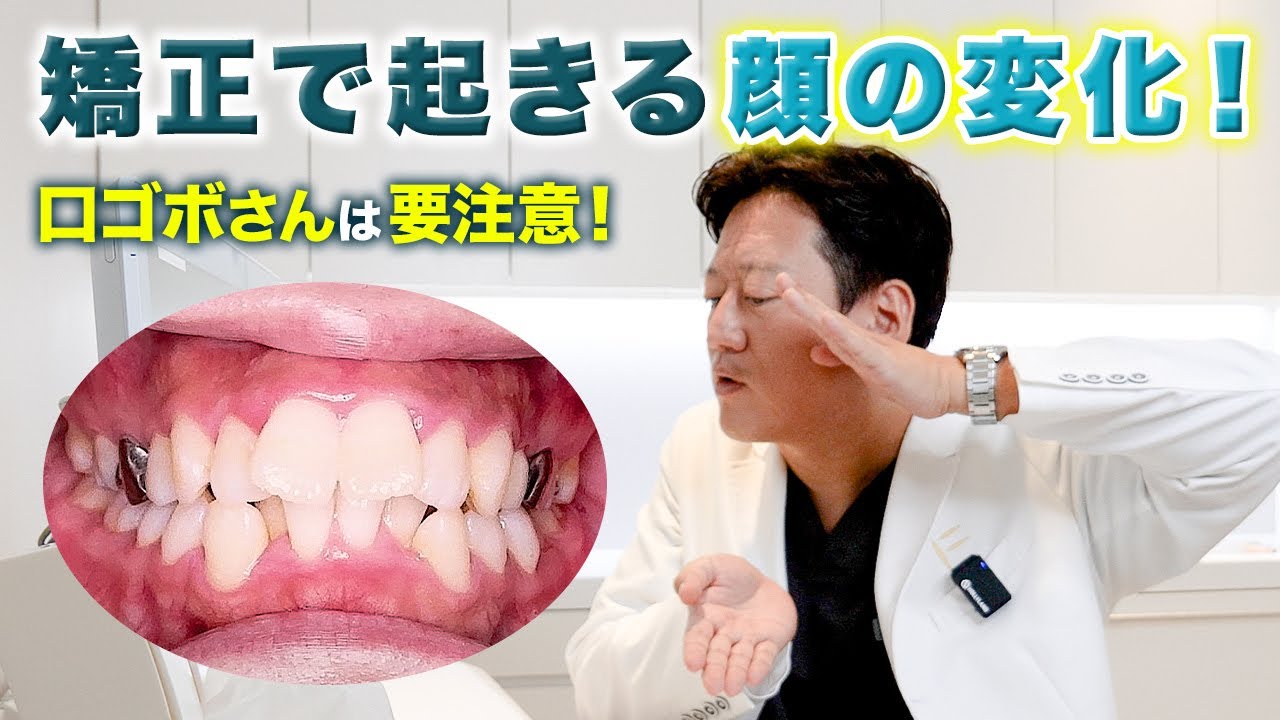 Eラインを整えたい！口ゴボの矯正治療で人中が伸びるって本当？【審美歯科 歯並び 口ゴボ Eライン】