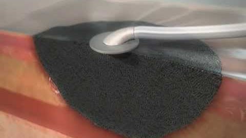 VAC Therapy Mechanisms of Action Animation