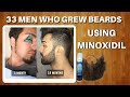 33 Men Who Grew Beards Using Minoxidil | The Minox Beard Spot | Minoxidil Beard Showcase