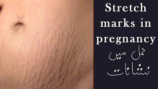 Stretch Marks In Pregnancy Urduhindi