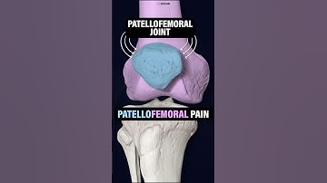 What Is Patellofemoral Pain (Runner’s Knee)? #shorts