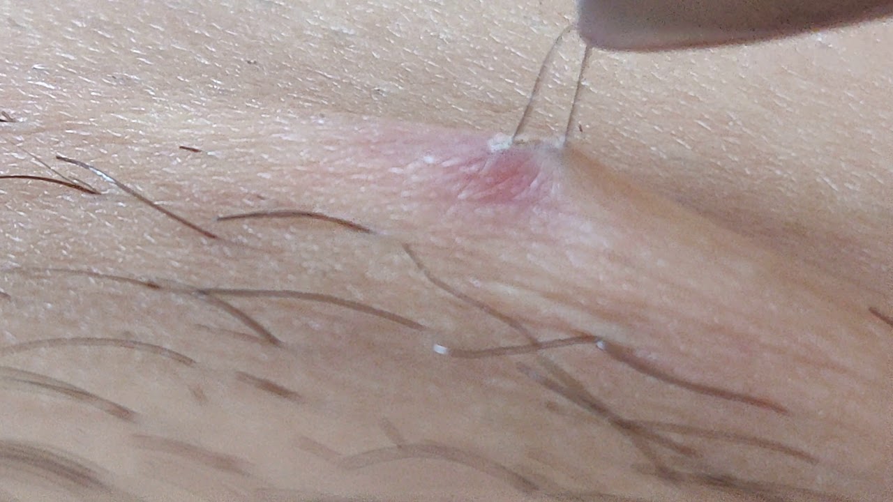 Infected Ingrown Hair Removal Youtube
