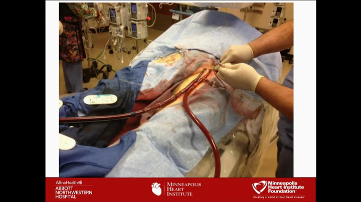 How to Treat STEMI Complications - Timothy Henry, MD