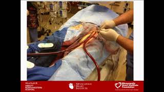 How to Treat STEMI Complications - Timothy Henry, MD screenshot 4