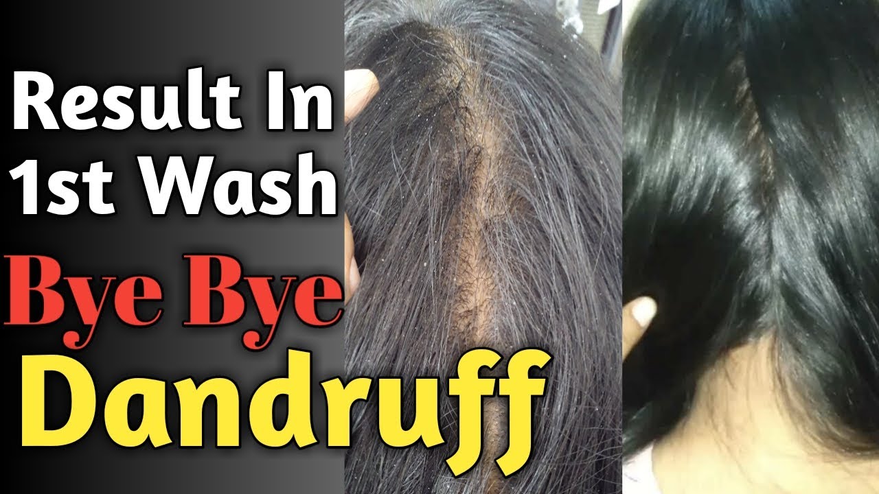 Dandruff kaise hataye? Dandruff treatment Result in 1st wash 100 