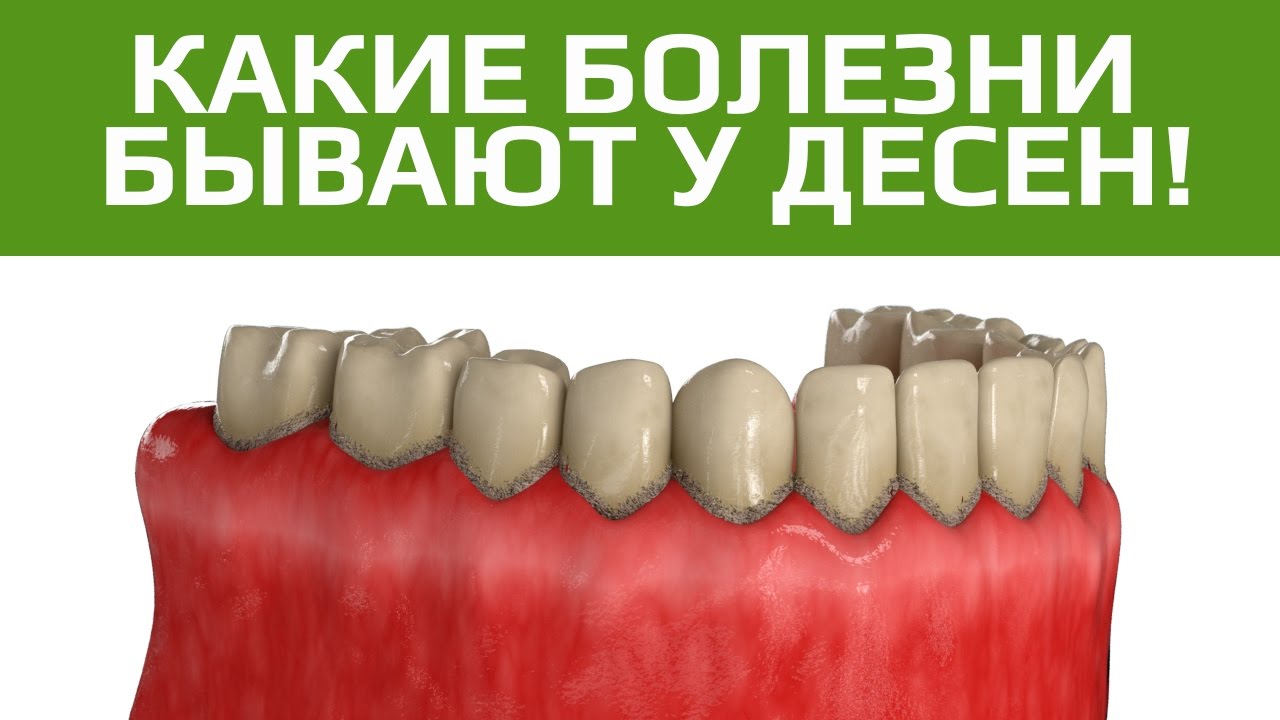 Какие заболевания десен бывают Удаление зубов под наркозом Томск Горького Максима