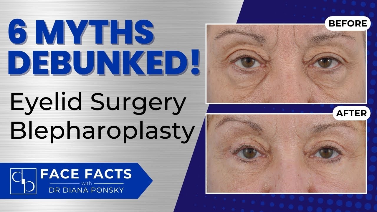 6 Myths About Eyelid Surgery - Blepharoplasty Debunked!