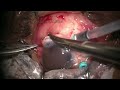 IOL Charades during Retinal Detachment Surgery