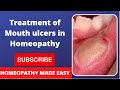 Treatment of mouth ulcers in homeopathy  subscribe our channel