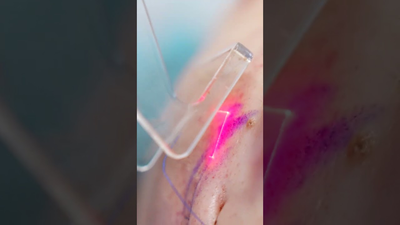 Laser Therapy to Support Healing After Facial Surgery