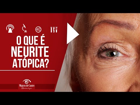 O que é a Neurite Óptica? -  Dr. Marcos de Castro Oftalmologia