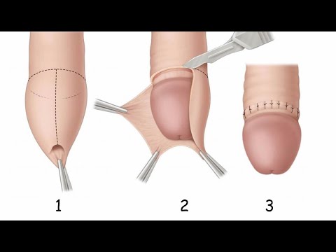 circumcise ASL
