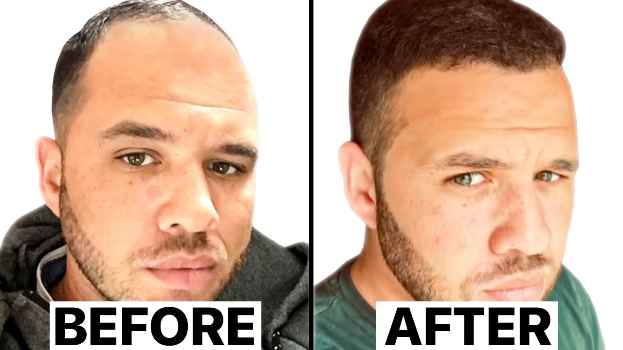 Life Changing Hair Transplant Makeover | Surgeon Reacts