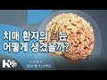 치매 환자의 뇌는 어떻게 생겼을까? - (20.03.25 생로병사의 비밀 스페셜 방송) 치매와의 전쟁-치매쇼크 치매혁명