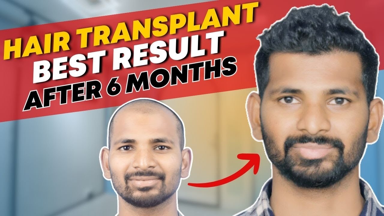 Share 139+ hair transplant in agra